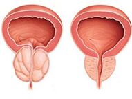 Prostatitis