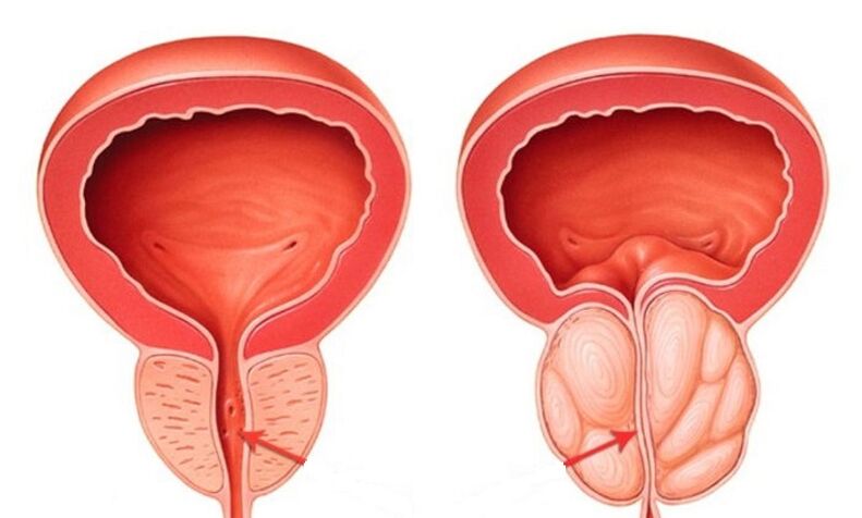 Healthy and inflamed prostatitis